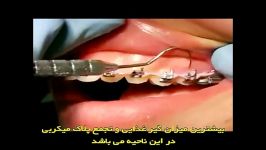 طریقه صحیح مسواک زدن دندانهای ارتودنسی شده زیرنویس
