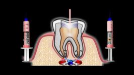 درمان ریشه دندان دندانپزشکی آبان