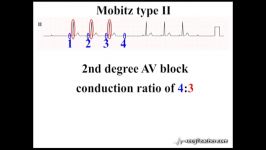 ‪31 ECGTeacher.com  Atrio Ventricular Block Section 5  Part 1