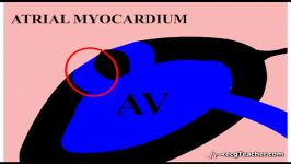 28 ‪ECGTeacher.com  AV Nodal Re entrant Tachycardia Section 4  Part 7‬