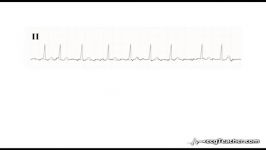 26 ECGTeacher.com  Atrial Fibrillation