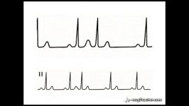 24 ECGTeacher.com  Fusion Section 4  Part 3