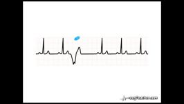 23 ECGTeacher.com  Ectopic Beats Section 4  Part 2