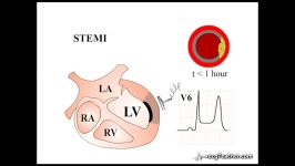 18 STEMI Section 3  Part 2