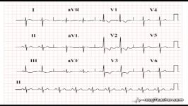 15 ‪ECGTeacher.com  Right Ventricular Hypertrophy Section 2  Part 9‬