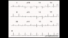 13 Left Ventricular Hypertrophy 1