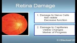 diabetic retinopathy 2