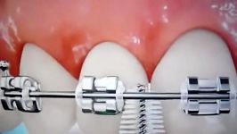 مراکز تخصصی ارتودنسی دکتر صدرالدینی مسواک بین دندانی