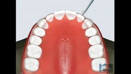 نحوه قرار دادن نگه دارنده ثابت fixed retainer