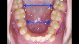 ارتودنسی بدون کشیدن دندان  دکتر مسعود داودیان