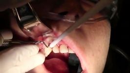 Flap Reflection And Atraumatic Extraction  Extraction