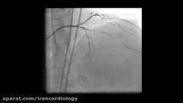 Severe LV dysfunction CRF CVA