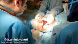 جراحی تعویض کامل مفصل لگن توسط دکتر جواهری