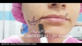 اسکار ترمیم زخم صورت 