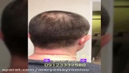 اسکالپ تخصصی روشی نوین برای رفع کم پشتی موهای سر