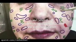 روشهای تخلیه ژل زبان سرپرست اولین تیم جراحی لیفت عمقی صورت در ایران