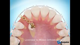 درمان ارتودنسی دندانهای نهفته در استخوان فک دندان نیش