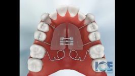 Quad Helix دستگاه عریض کننده فک بالا