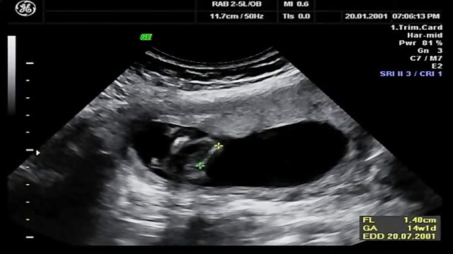 سونوگرافی 4 بعدی جنین در 15 هفتگیپایان سه ماهگی