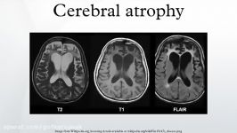 درمان آتروفی مغزی.09120452406.توانبخشی آتروفی مغزی.آتروفی مغز