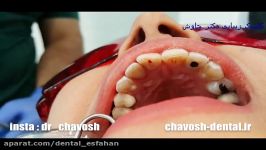 ترمیم تحلیل ریشه دندان  کلینیک دندانپزشکی زیبایی چاوش  1