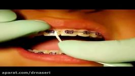نحوه کشیدن نخ دندان در ارتودنسی ،متخصص ارتودنسی اصفهان ،دکتر محمد علی ناصری