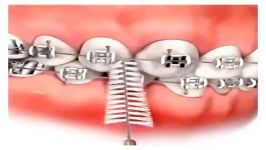 متخصص ارتودنسی اصفهان ،نحوه استفاده مسواک بین دندانی در ارتودنسی