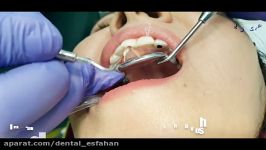ترمیم تحلیل ریشه دندان  کلینیک دندانپزشکی زیبایی چاوش  2