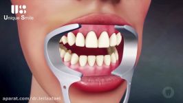 بلیچینگ دندان  دکتر لیلا عطایی
