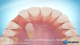 متخصص ارتودنسی کودکان اصفهان ،نحوه درمان ارتودنسی دندان نیش نهفته