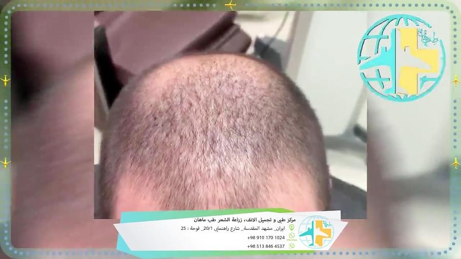 زراعة الشعر بمرکز طب ماهان فی ایران مشهد المقدسة