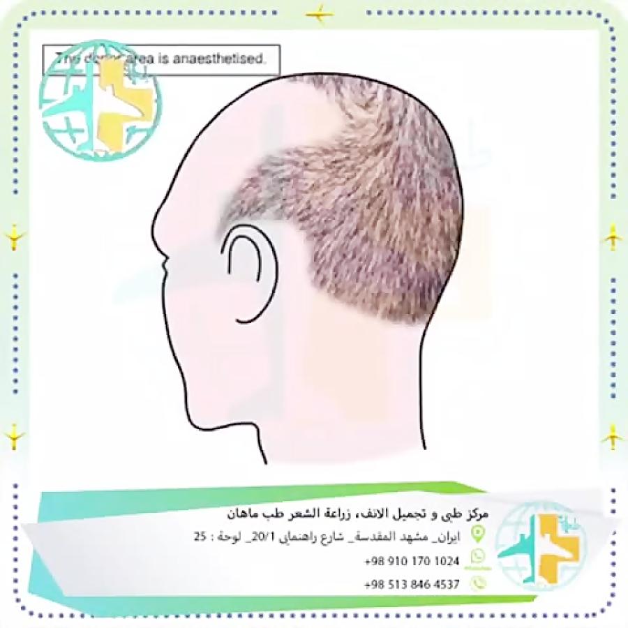 زراعة الشعر فی افضل المرکز التجمیل علی ایران مشهد