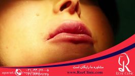 تزریق ژل  فیلم تزریق ژل  کلینیک پوست مو رز  شماره 15