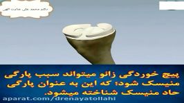 پارگی منیسک زانو ؟