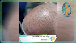 زراعة الشعر بمرکز تجمیل طب ماهان فی مشهد