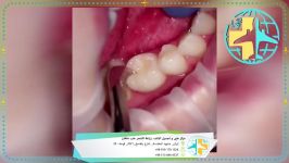 کیفیة تشغیل عملیة لومینیر الأسنانابتسامة هولیوود مع مرکز التجمیل طب ماهان فی ای