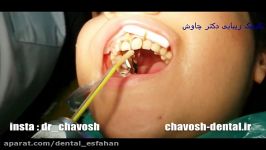 8 واحد کامپوزیت ونیر دندان در اصفهان  دندانپزشکی زیبایی چاوش