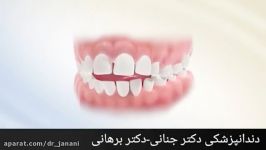 دستگاه تانگ کریپ برای جلوگیری بیرون زدگی دندان ها