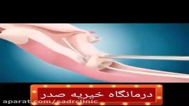 نحوه گذاشتن iud