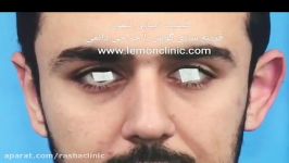 قرینه سازی گوش ها اصلاح نمای نیمرخ توسط تیم جراح لمون