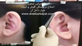 مشخصات برجستگی گوش روش درمان آن در معتبرترین مرکز جراحی گوش تهران