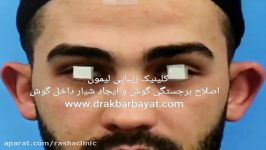 اصلاح غضروف گوش به منظور برطرف کردن بیرون زدگی گوشها