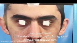 هم سایز سازی هم شکل کردن گوشها توسط تیم جراحی لمون