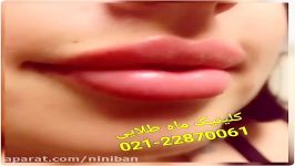 نی نی بان  تزریق ژل بوتاکس، تخفیف ویژه به مدت محدود