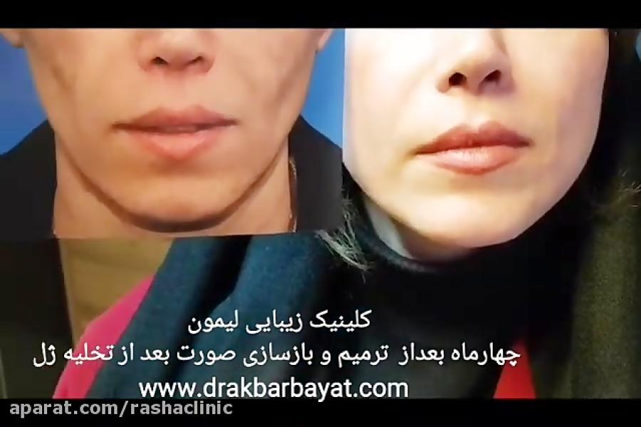 روند درمان عوارض ژل به همراه بازگردندان زیبایی صورت توسط تیم جراحی لمون