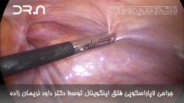 فیلم جراحی لاپاراسکوپی فتق اینگوینال توسط دکتر داود نریمان زاده