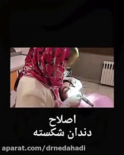 اصلاح دندان شکسته  دکتر ندا هادی دنداپزشک ترمیمی