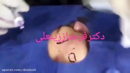 پر کردن گودی اسکار آکنه فیلر ژل