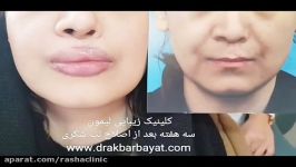 اصلاح اسکار روی لب ایجاد تناسب بین لبها توسط تیم جراحی لیمون