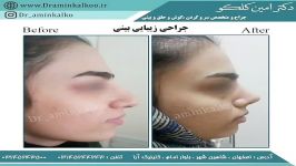 نمونه های جراحی بینی توسط جراح بینی اصفهان